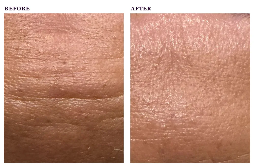 Before and after photos of an anti-aging facial treatment