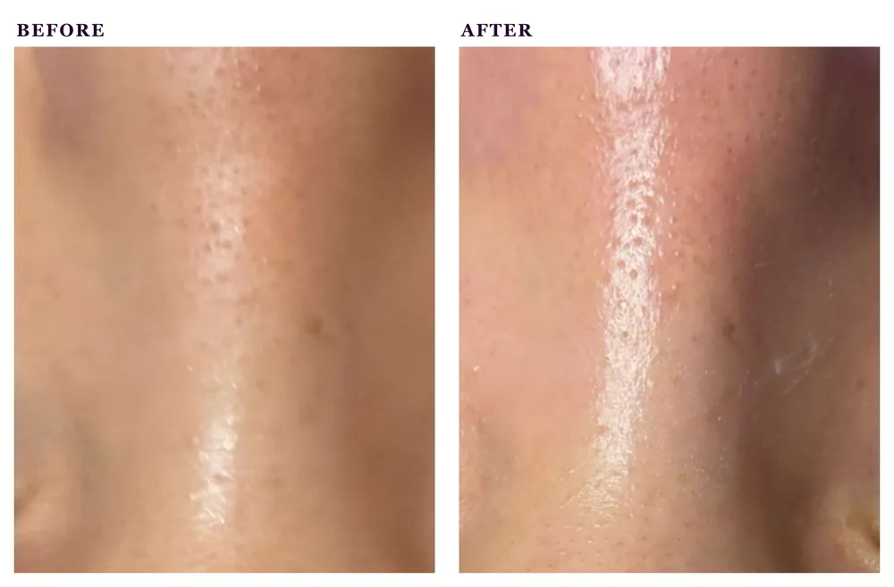 Before and after photos of a deep cleansing and blackhead removal facial