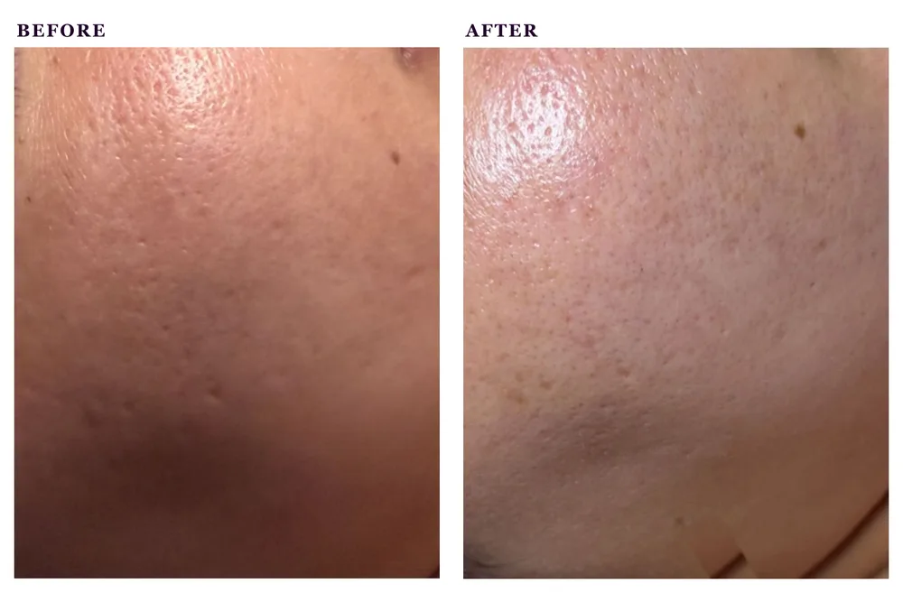 Before and after photos of a dermaplaning treatment