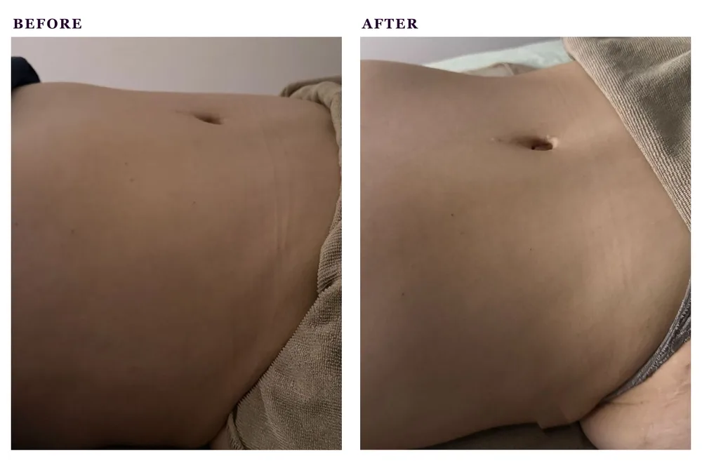 Before and after photos of a lymphatic drainage treatment