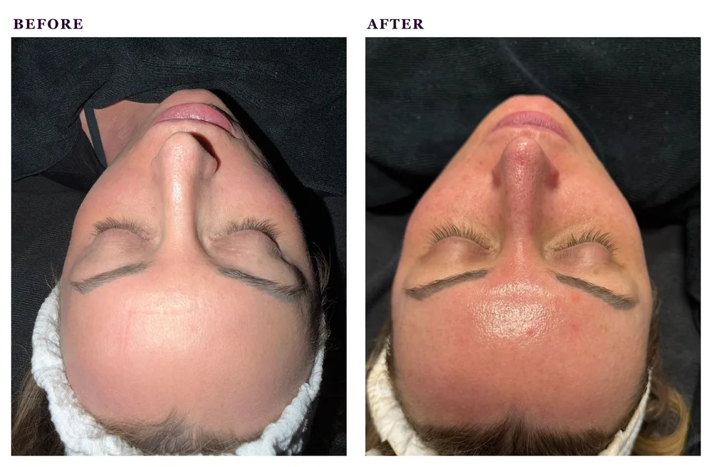 Before and after photos of a professional hydrating facial treatment