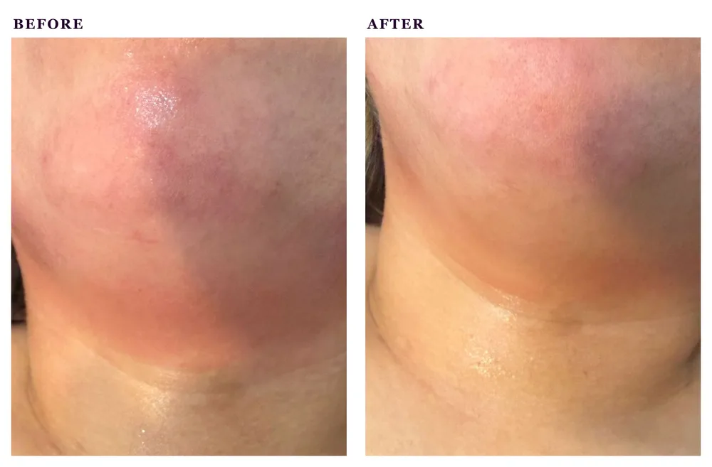 Before and after photos of a radio frequency treatment targeting the jawline and double chin